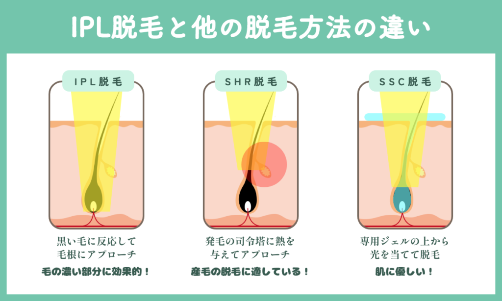 IPL脱毛と他の脱毛方法の違いをご説明。IPL脱毛は毛の濃い部分に効果的です。SHR脱毛は産毛の脱毛に適しています。また、SSC脱毛は肌に優しいのが特徴です。